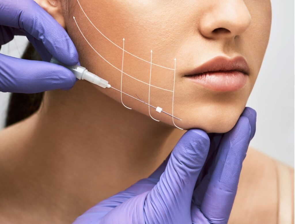 Thread Lifts Become a Popular Choice for Younger Skin