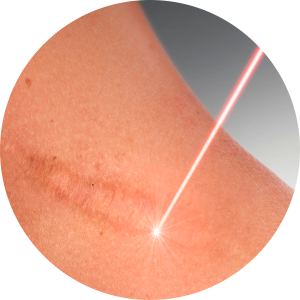 Best Clinic for Ance and Acne Scar Treatments in Adajan