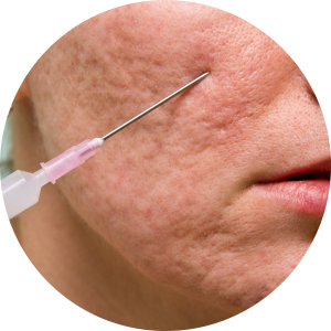 Best Clinic for Ance and Acne Scar Treatments in Adajan