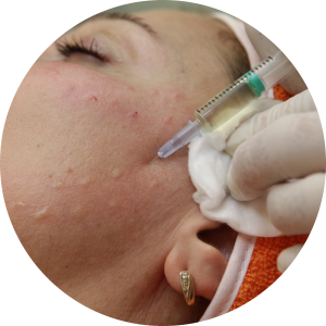 Best Clinic for Ance and Acne Scar Treatments in Adajan